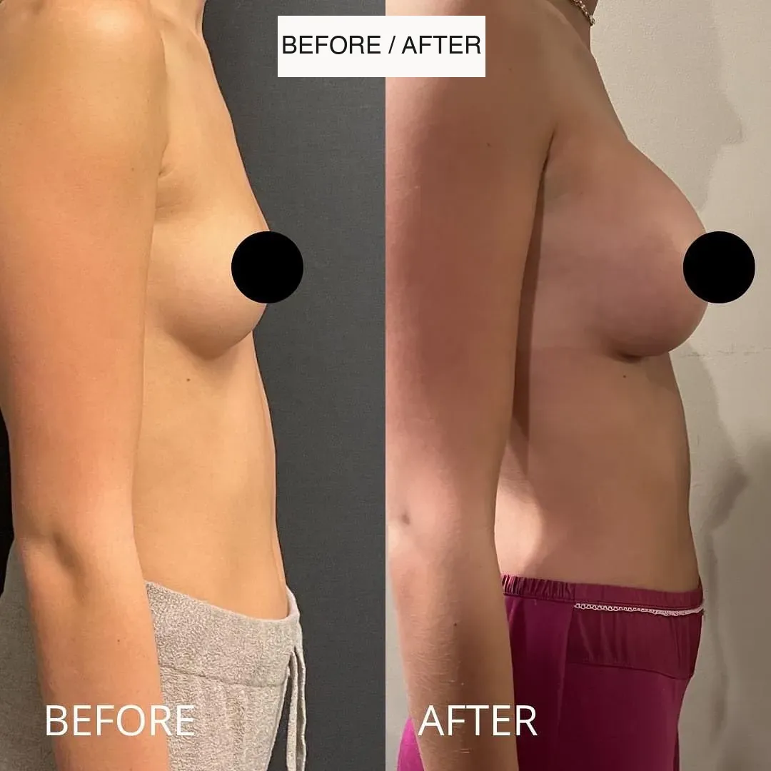 Breast surgery before-and-after comparison.