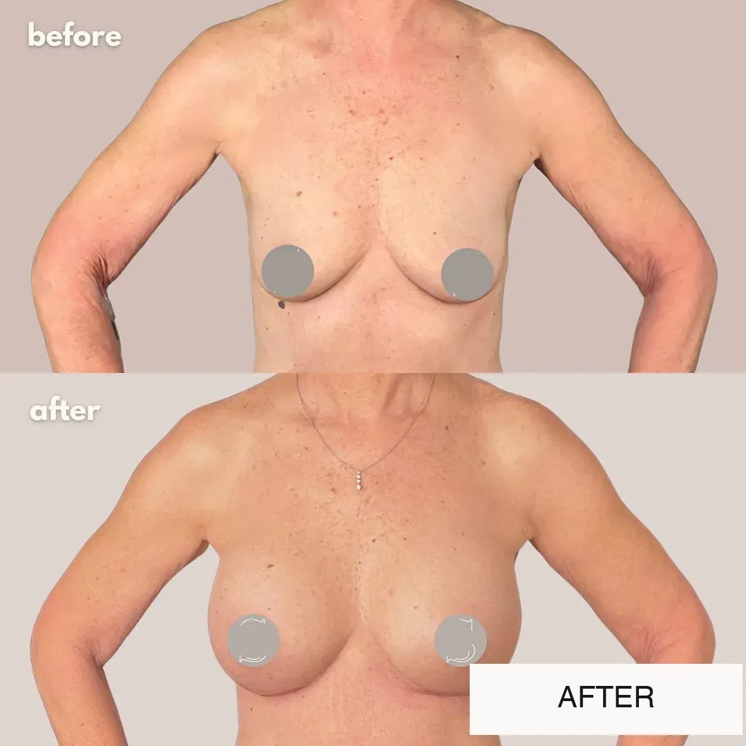 Breast surgery before-and-after comparison.
