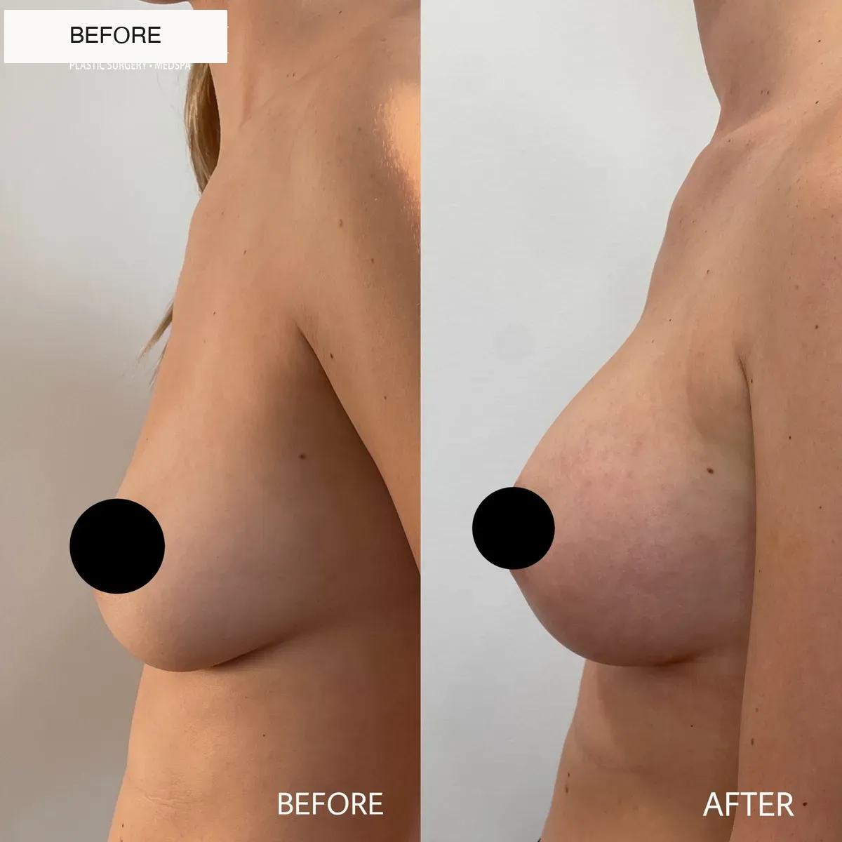Breast surgery before-and-after comparison.