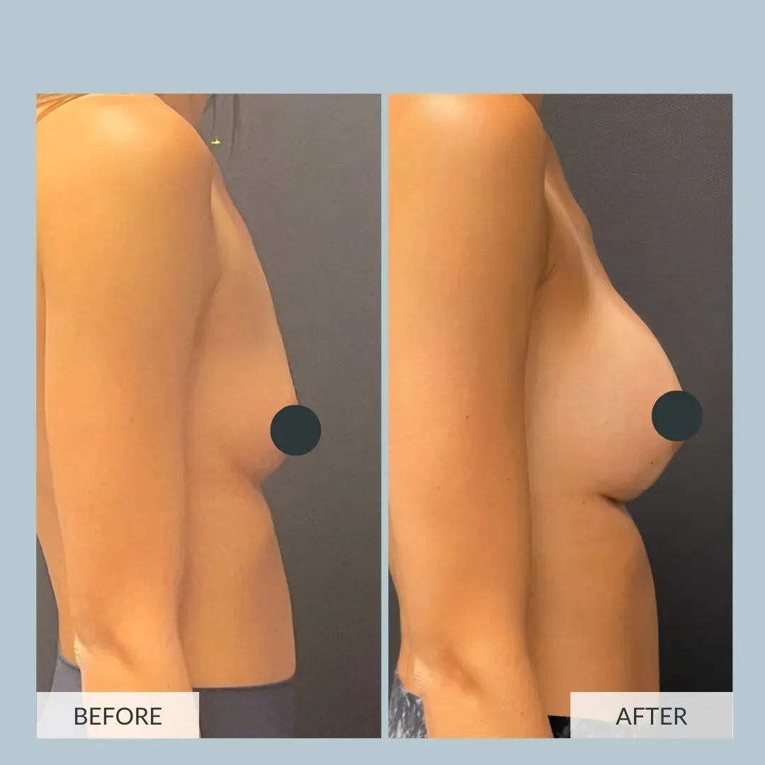 Breast surgery before-and-after comparison.