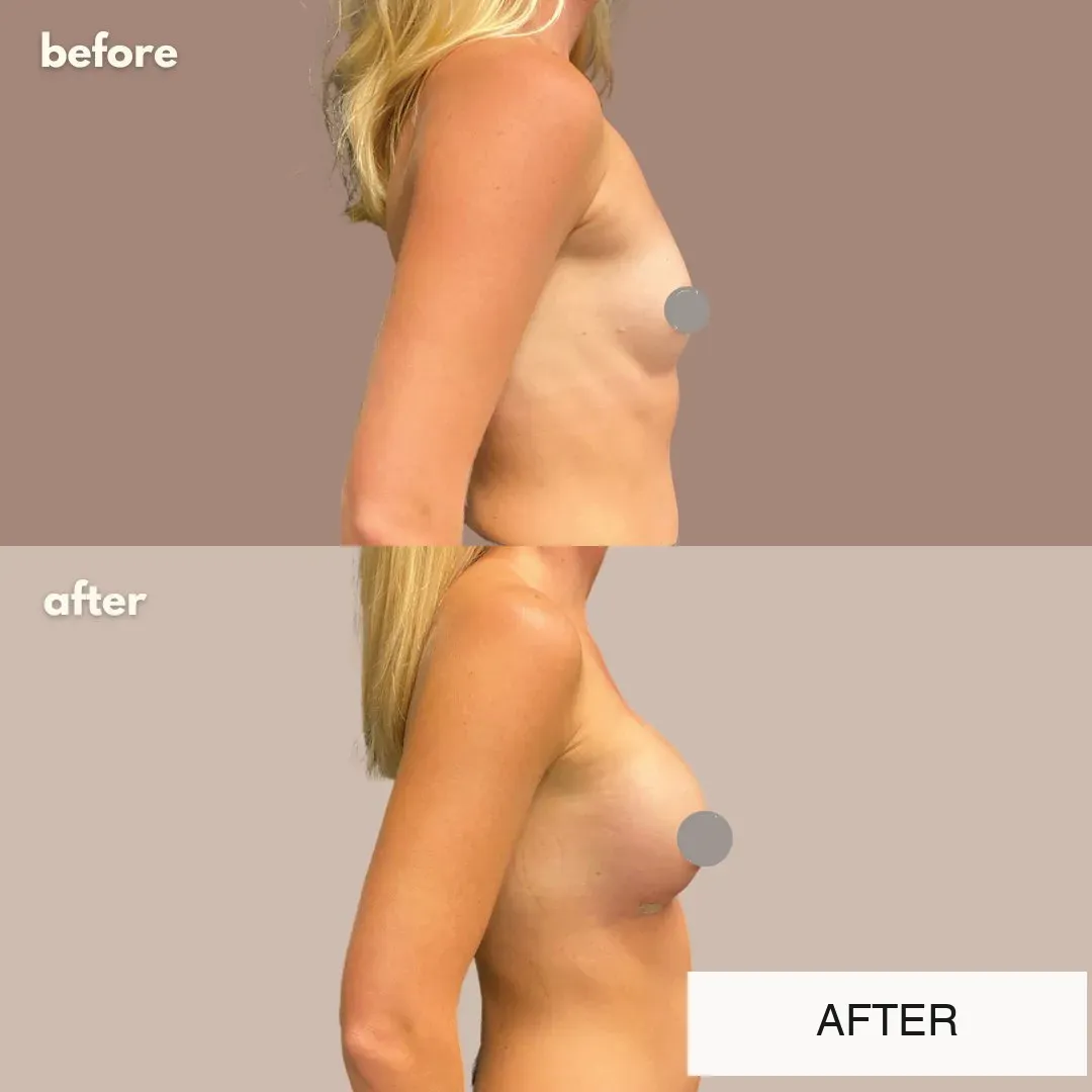 Breast surgery before-and-after comparison.