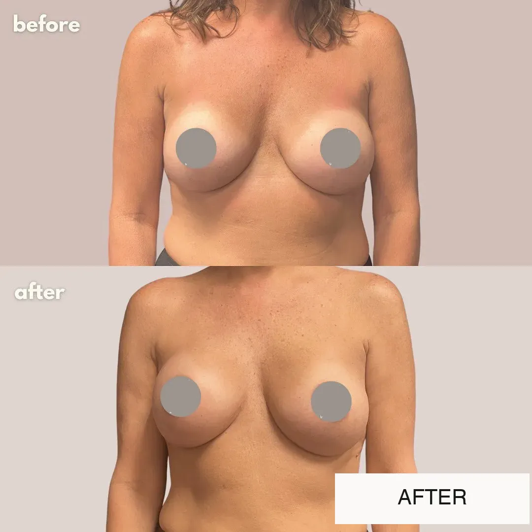 Breast surgery before-and-after comparison.