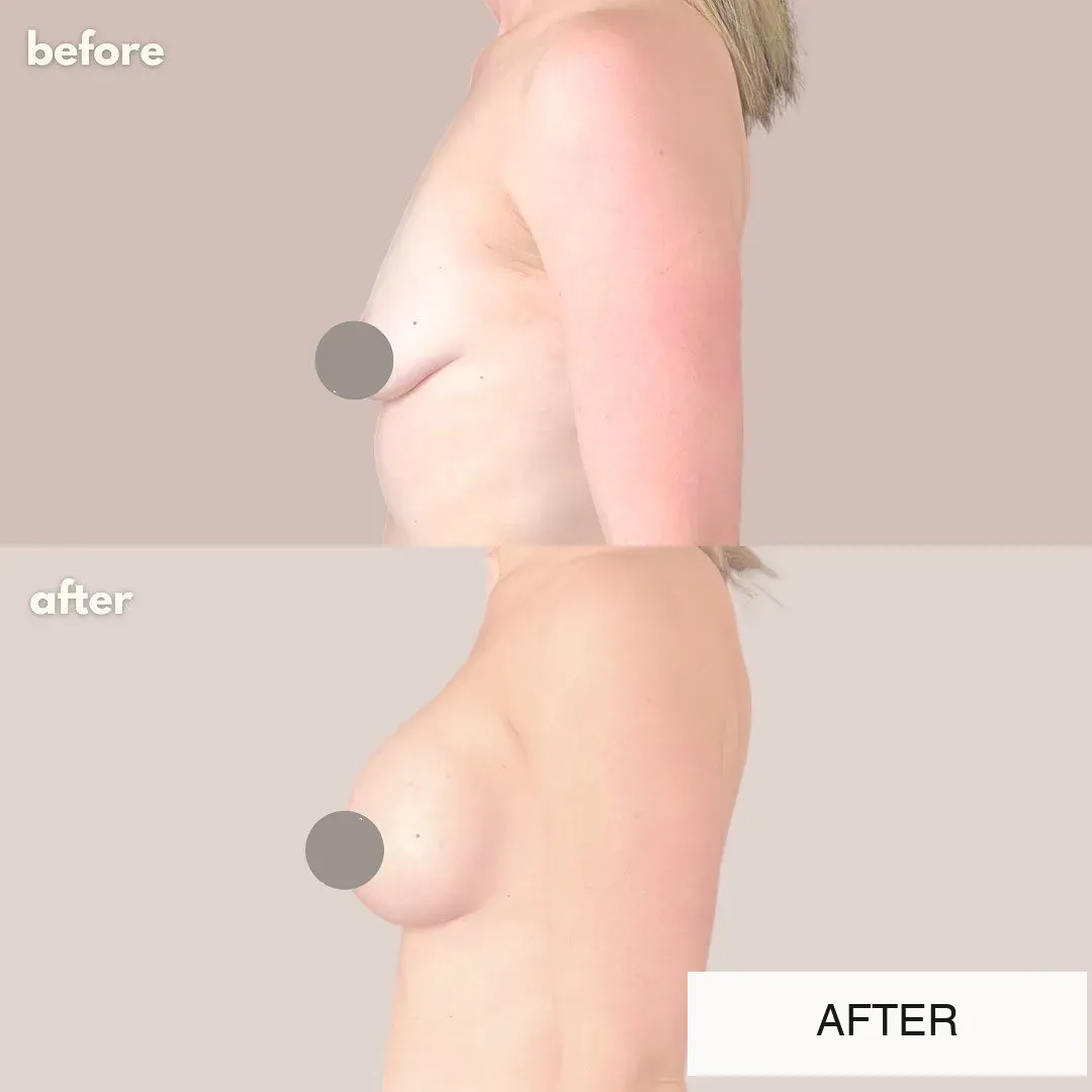 Breast surgery before-and-after comparison.