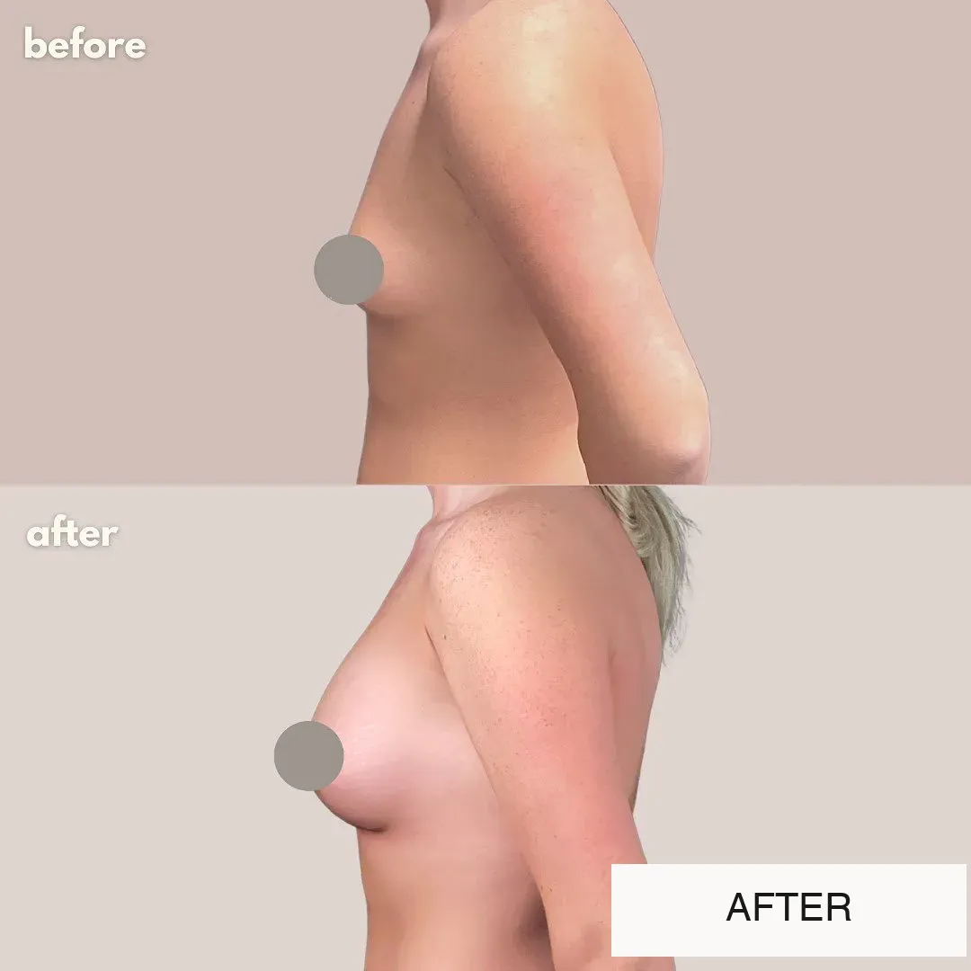 Breast surgery before-and-after comparison.