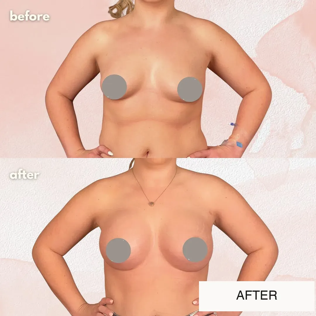 Breast surgery before-and-after comparison.