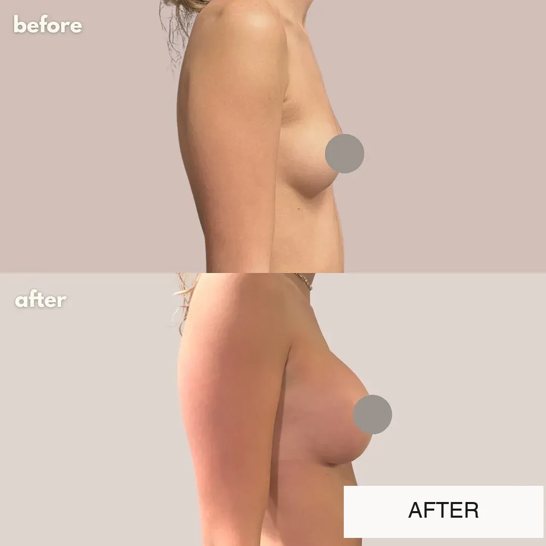 Breast surgery before-and-after comparison.