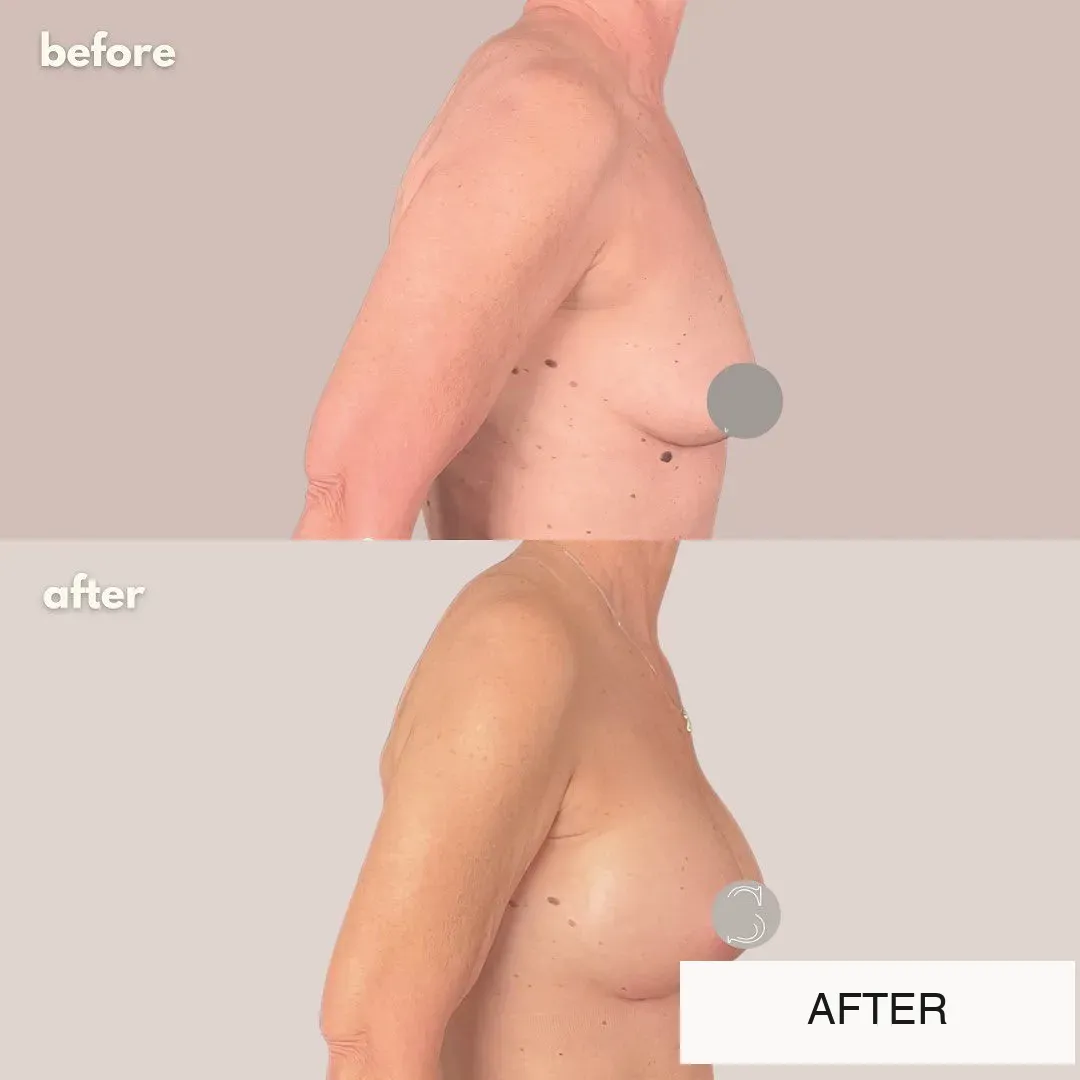 Breast surgery before-and-after comparison.