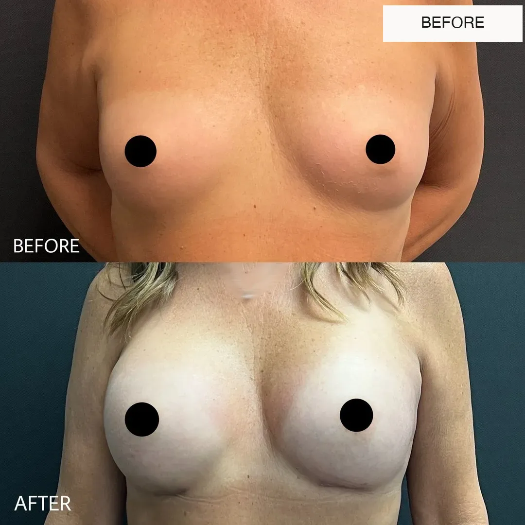Breast surgery before-and-after comparison.