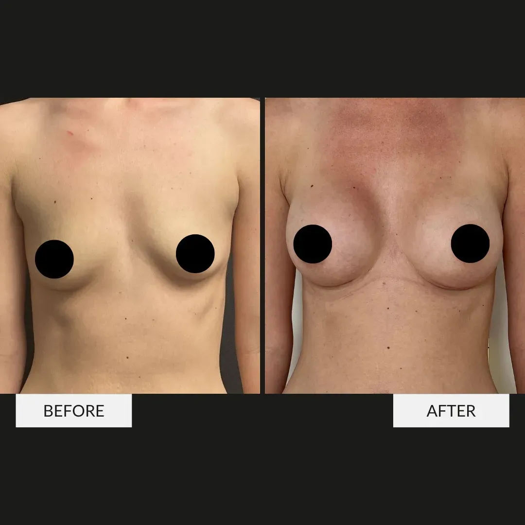 Breast surgery before-and-after comparison.