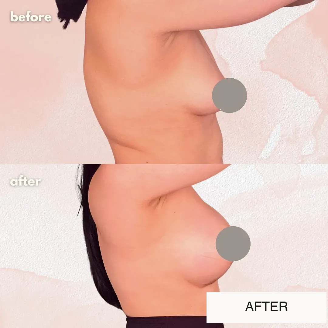 Breast surgery before-and-after comparison.