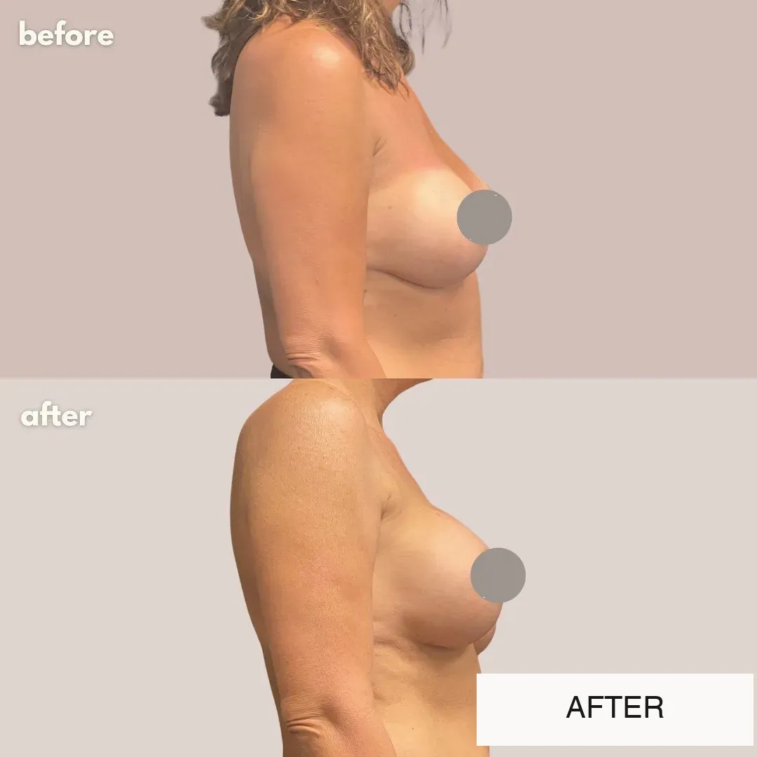 Breast surgery before-and-after comparison.