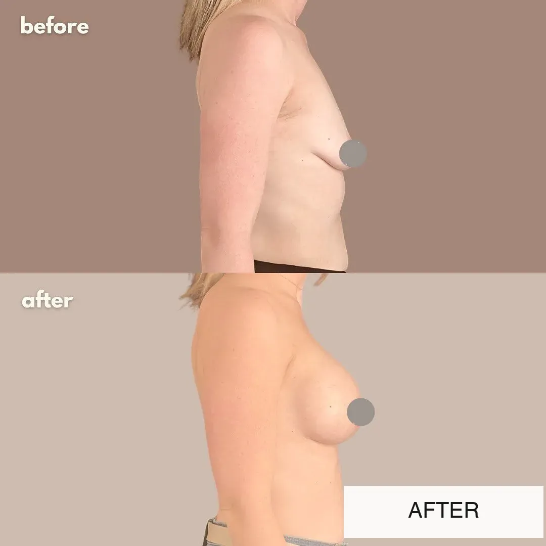 Breast surgery before-and-after comparison.