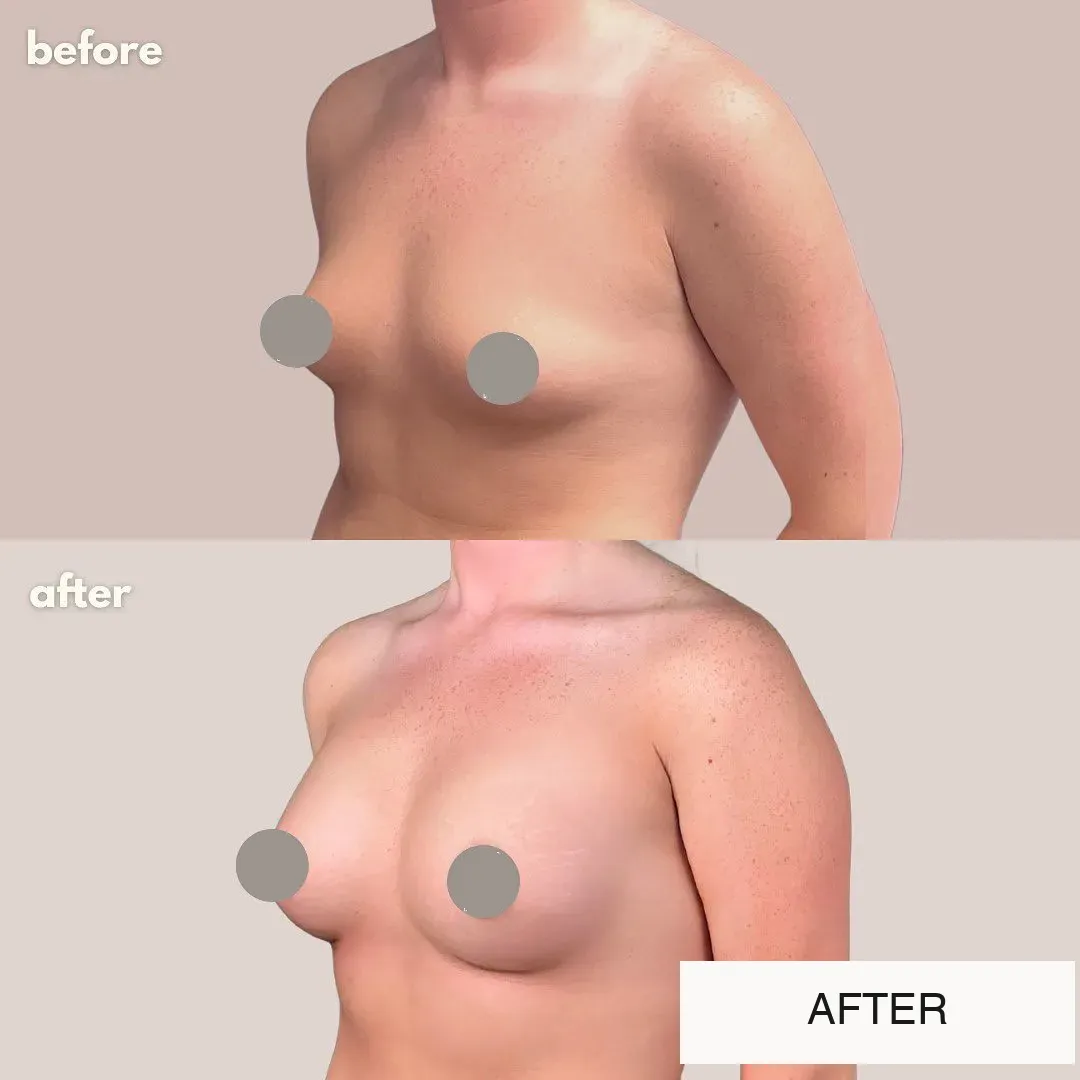 Breast surgery before-and-after comparison.