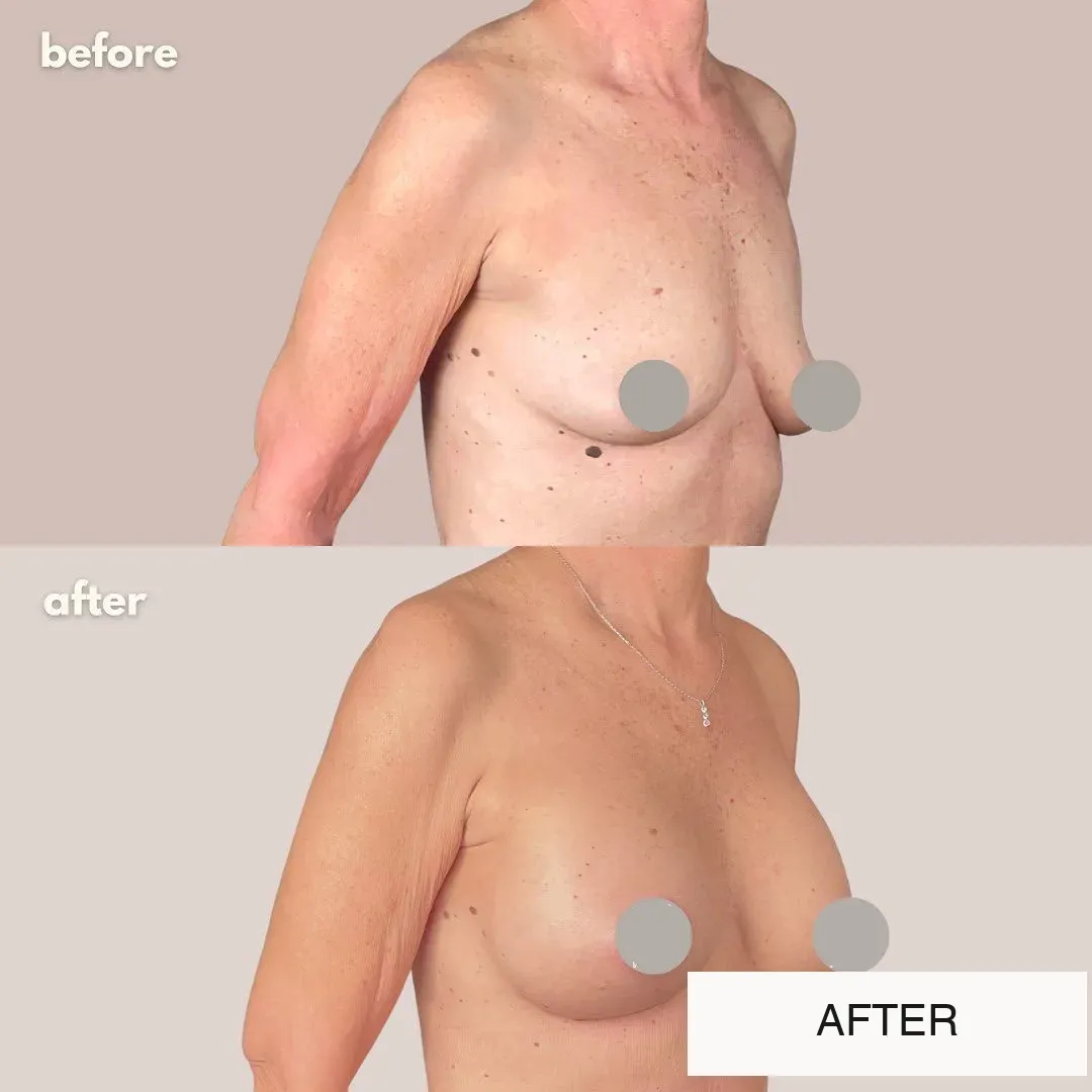 Breast surgery before-and-after comparison.