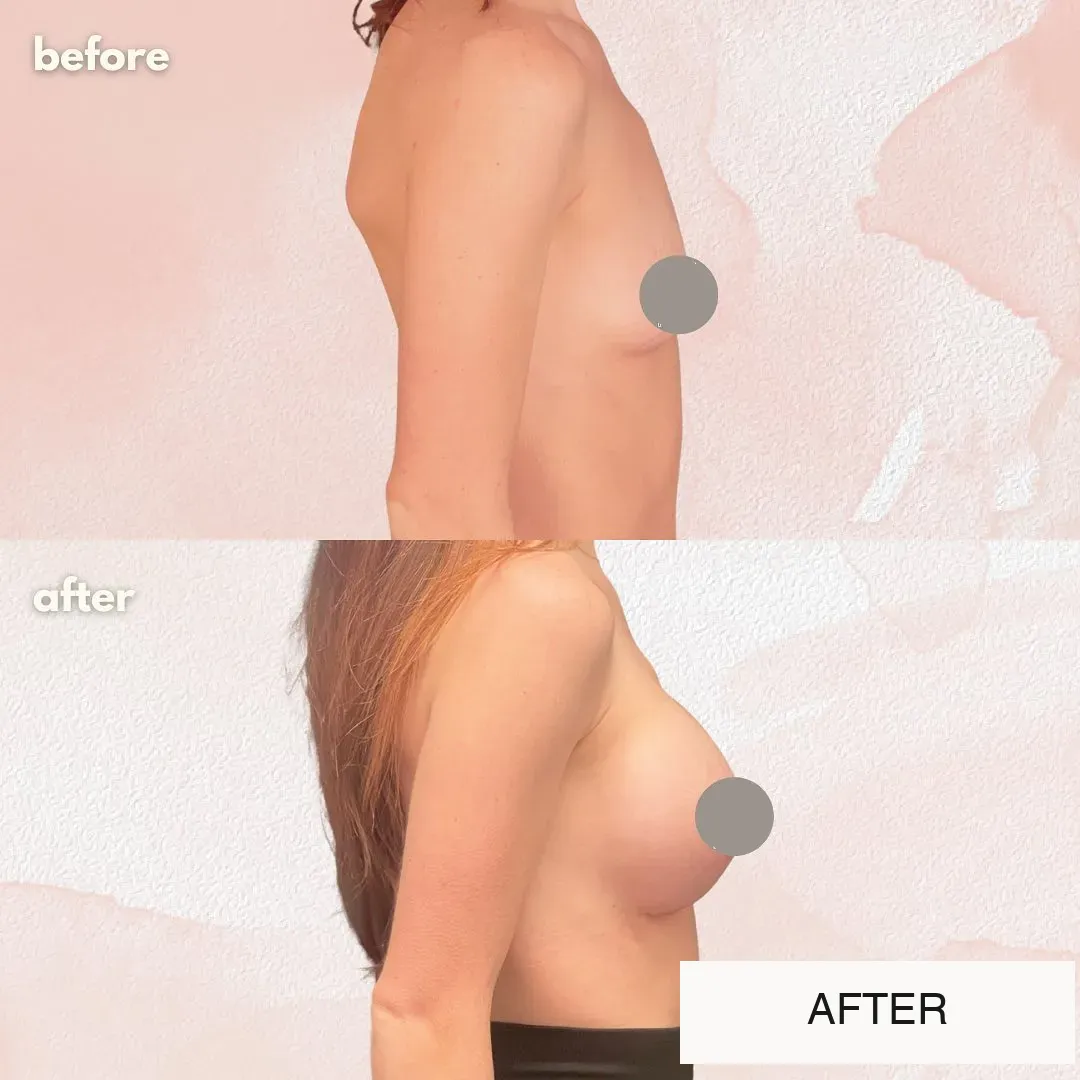 Breast surgery before-and-after comparison.