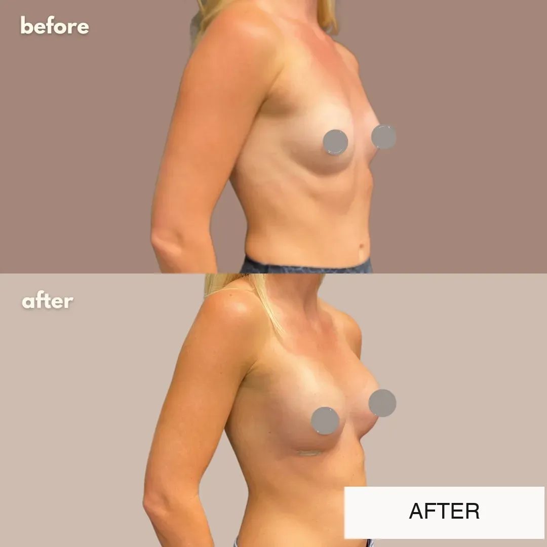 Breast surgery before-and-after comparison.