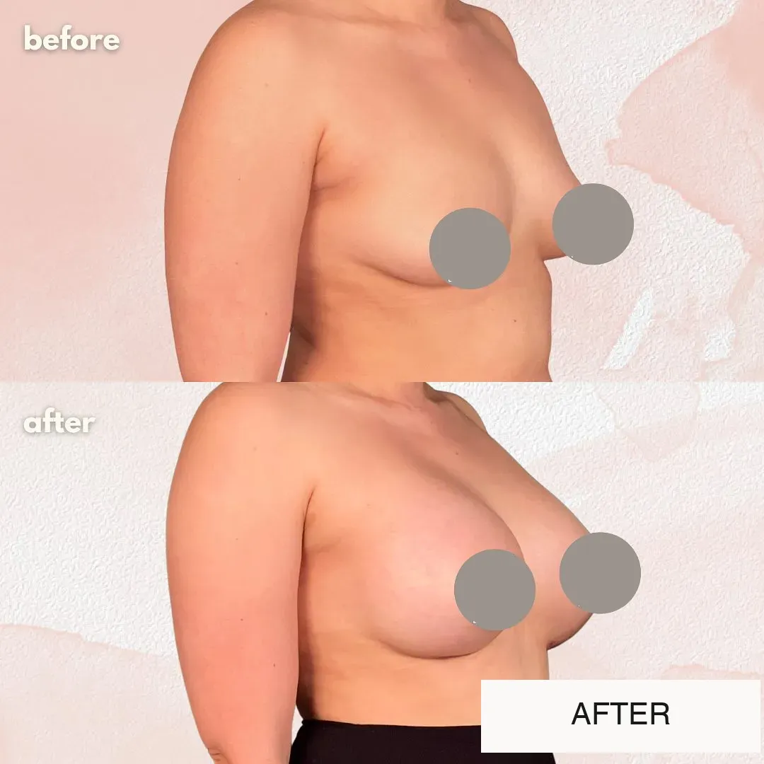 Breast surgery before-and-after comparison.