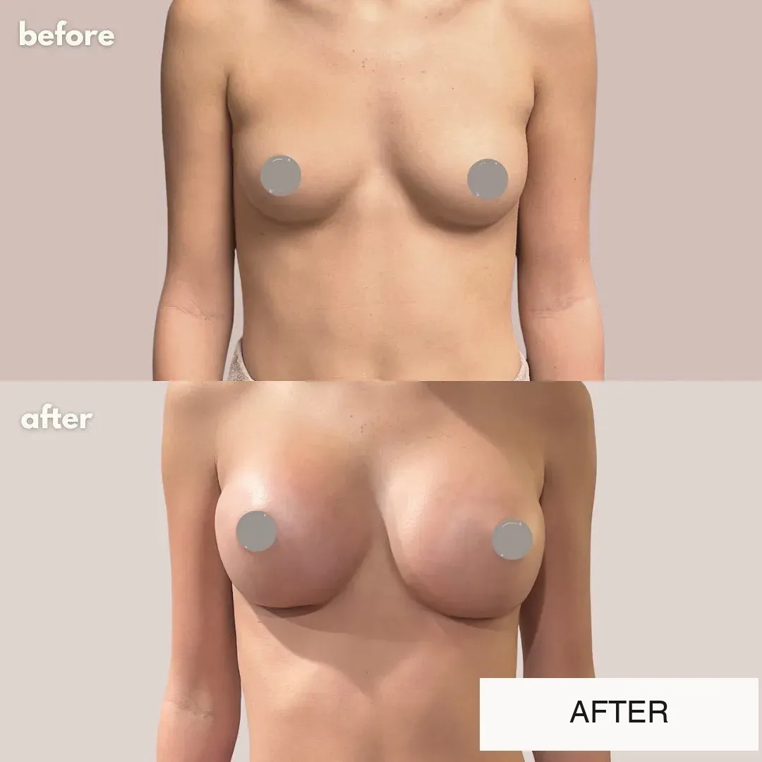 Breast surgery before-and-after comparison.