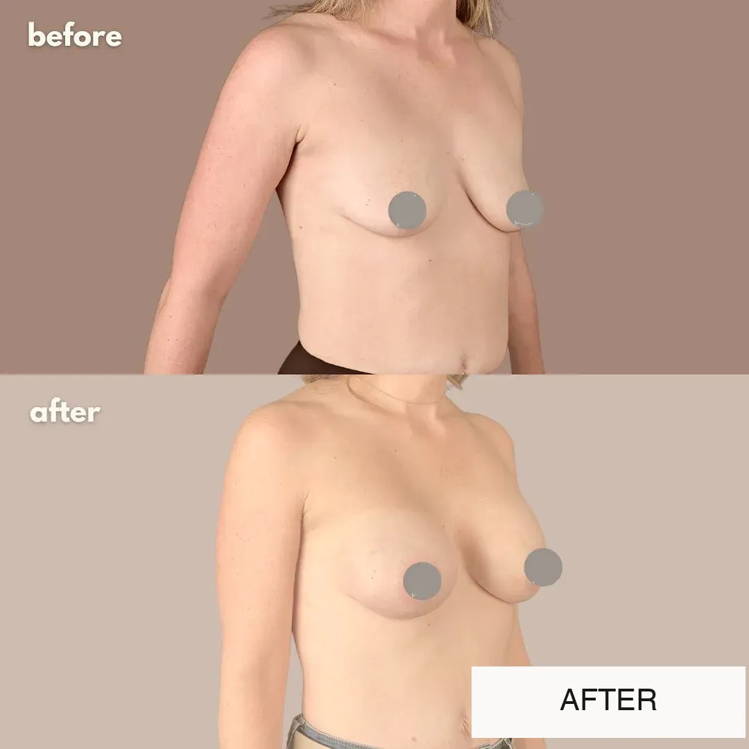 Breast surgery before-and-after comparison.