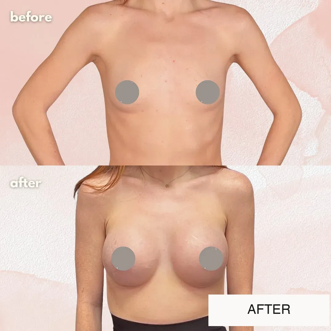Breast surgery before-and-after comparison.