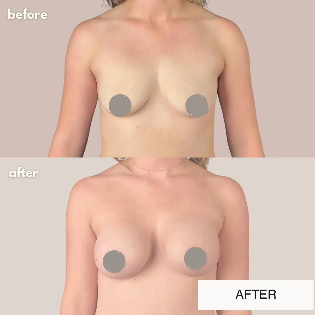 Breast surgery before-and-after comparison.