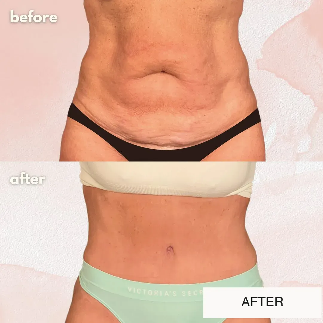 Tummy tuck before-and-after comparison, front view.