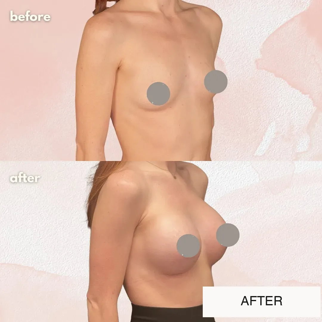 Breast surgery before-and-after comparison.