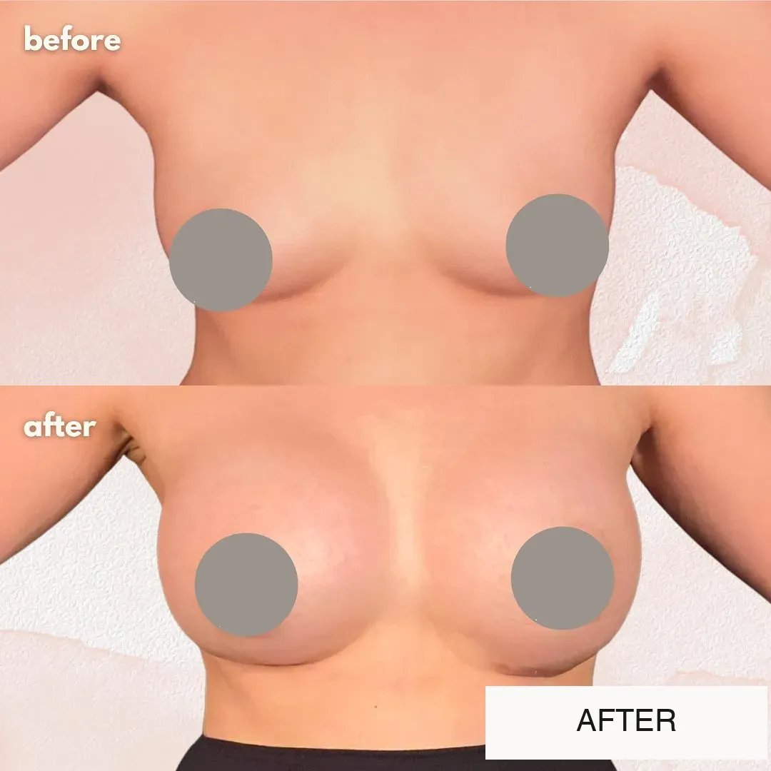 Breast surgery before-and-after comparison.
