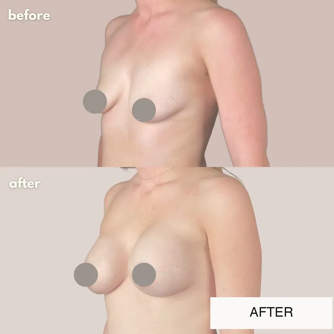 Breast surgery before-and-after comparison.