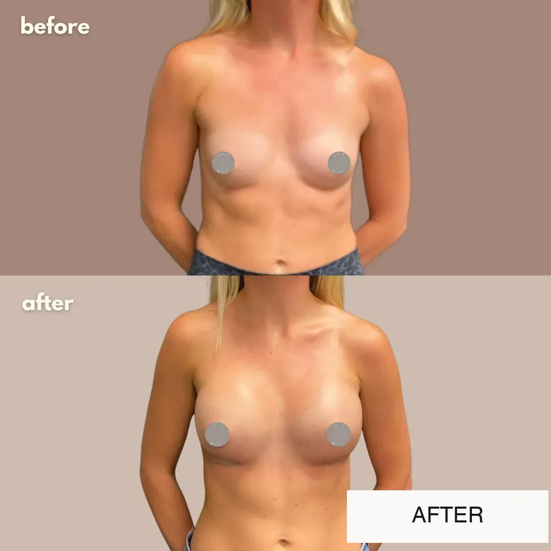 Breast surgery before-and-after comparison.
