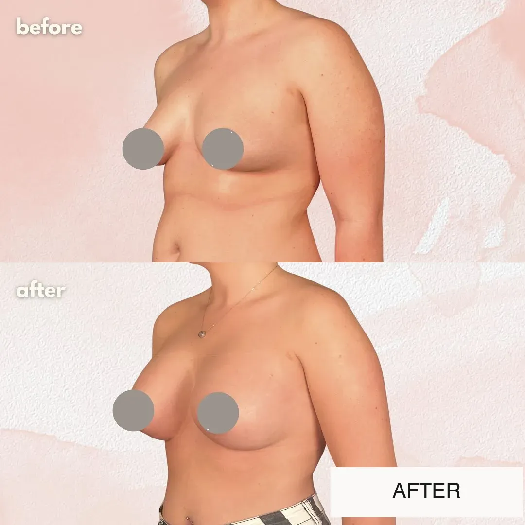 Breast surgery before-and-after comparison.