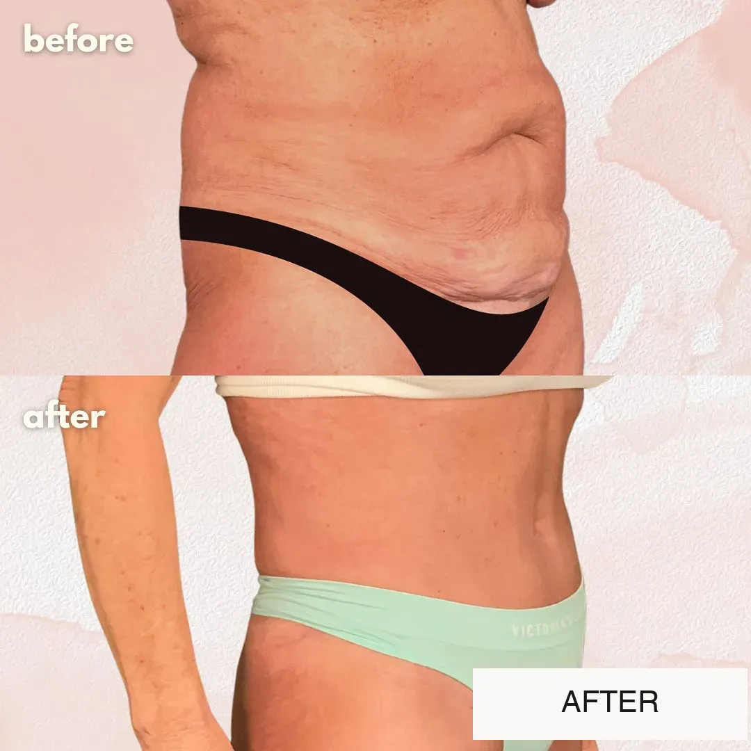 Tummy tuck before-and-after comparison, oblique view.