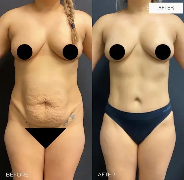 Tummy tuck before-and-after comparison, front view.