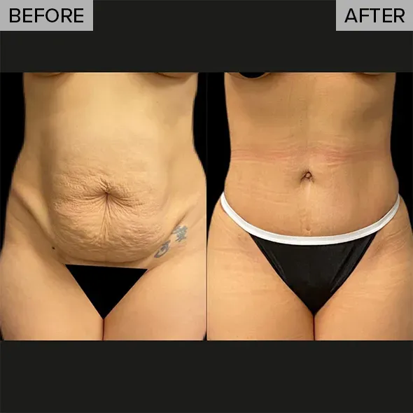 Tummy tuck before-and-after comparison, front view.