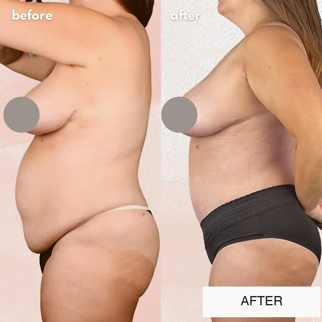 Tummy tuck before-and-after comparison, side view.