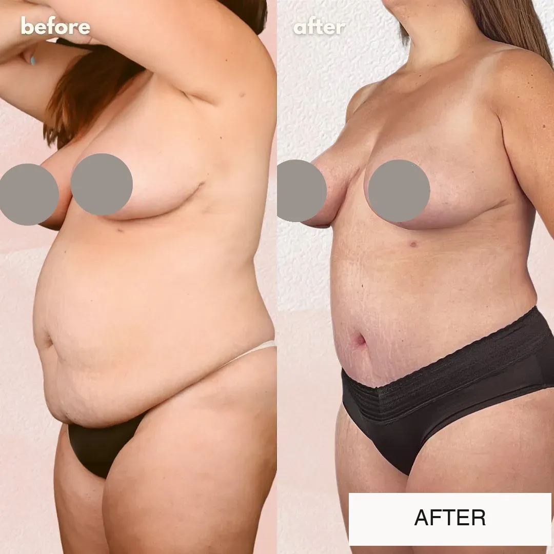 Tummy tuck before-and-after comparison, oblique view.