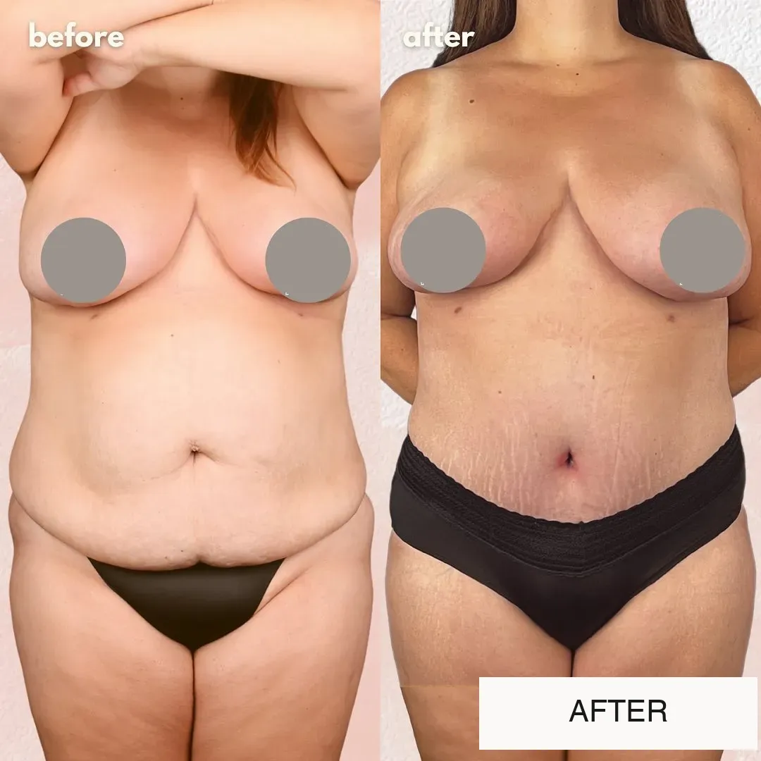 Tummy tuck before-and-after comparison, front view.