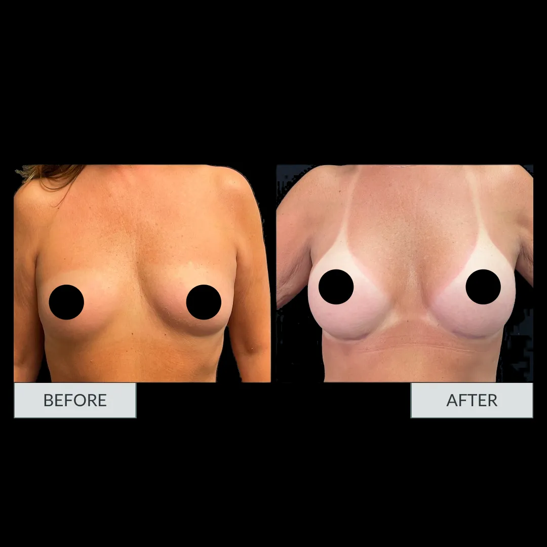 Breast augmentation before-and-after comparison, result 3