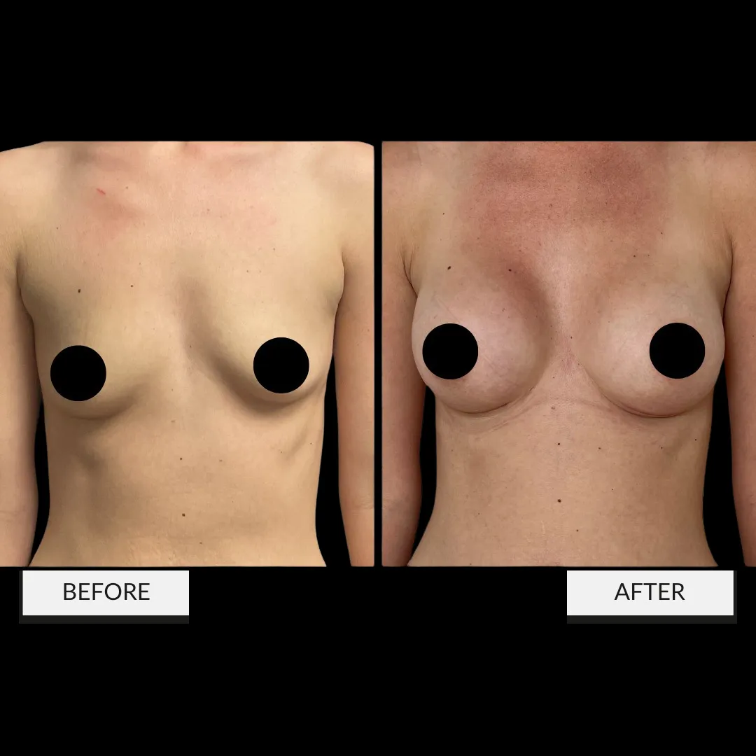 Breast augmentation before-and-after comparison, result 2