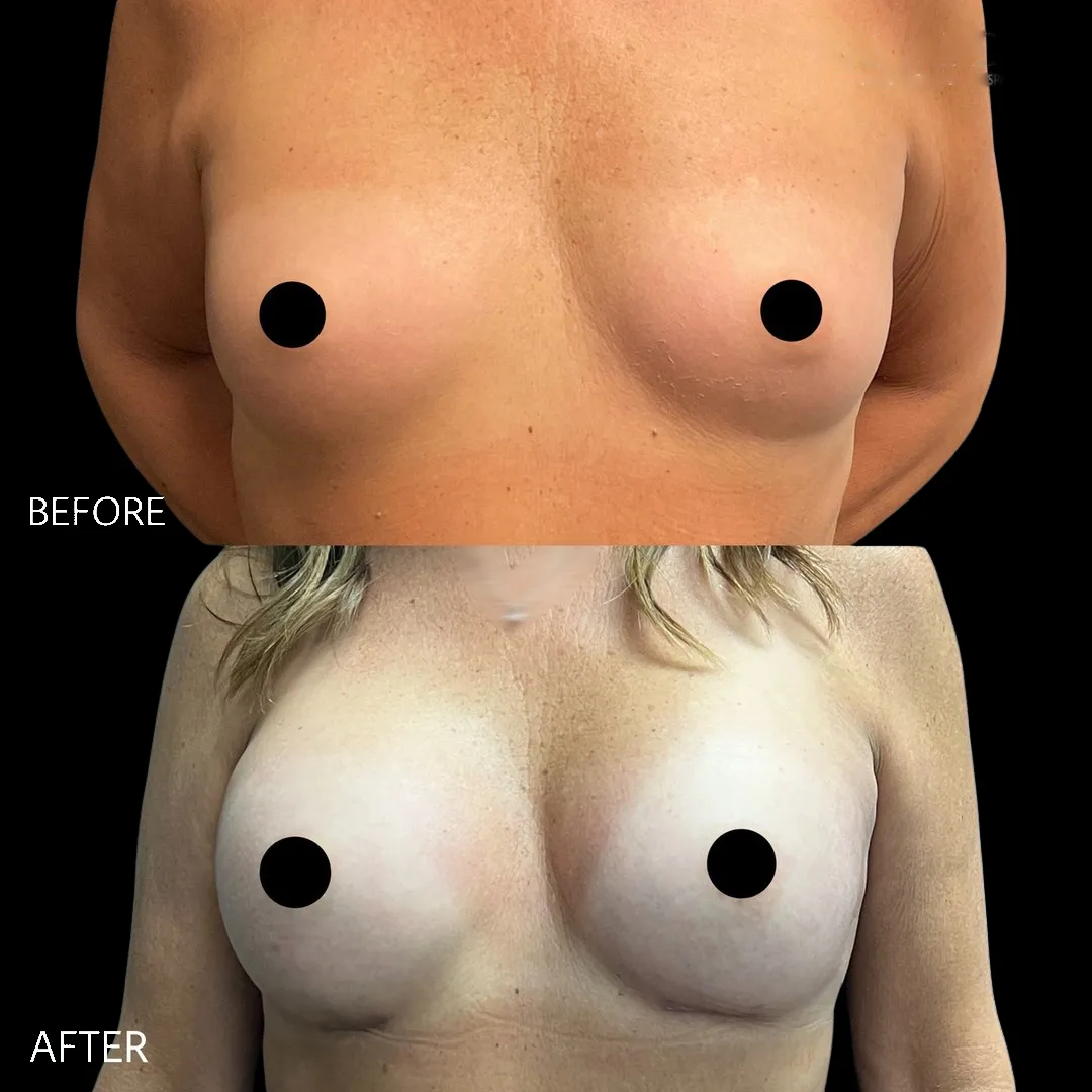 Breast augmentation before and after — case 4