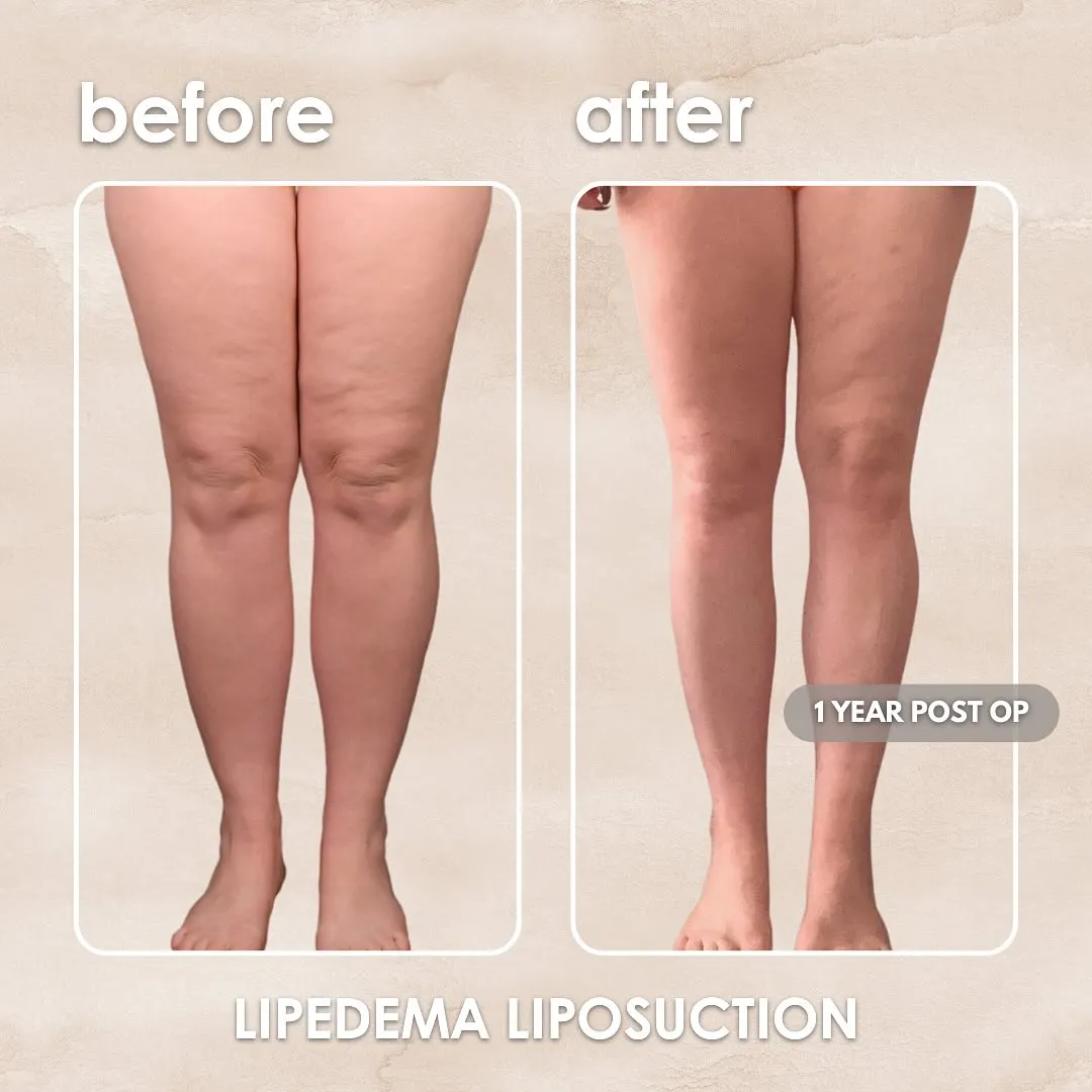 Lipedema before-and-after comparison.