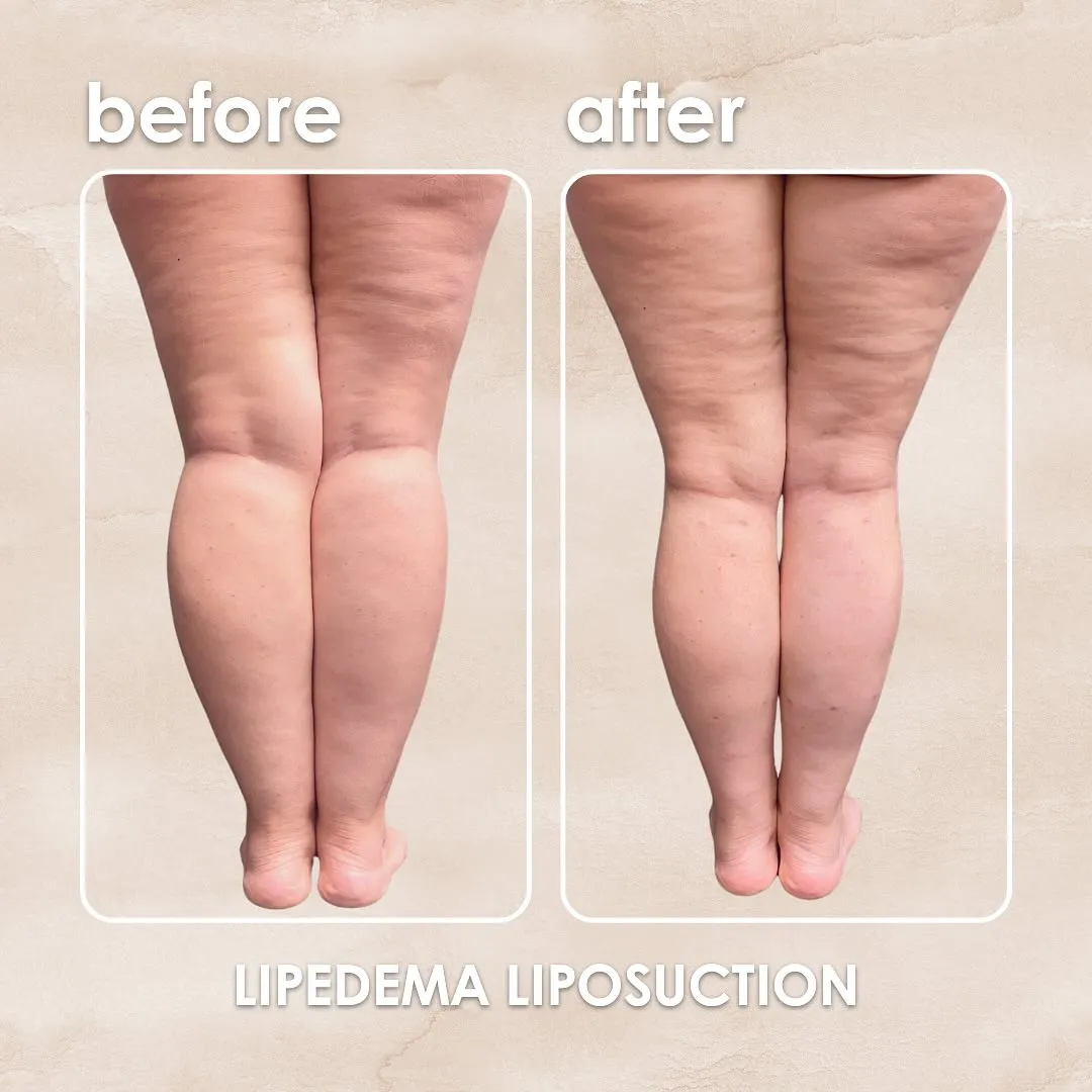 Lipedema before-and-after comparison.