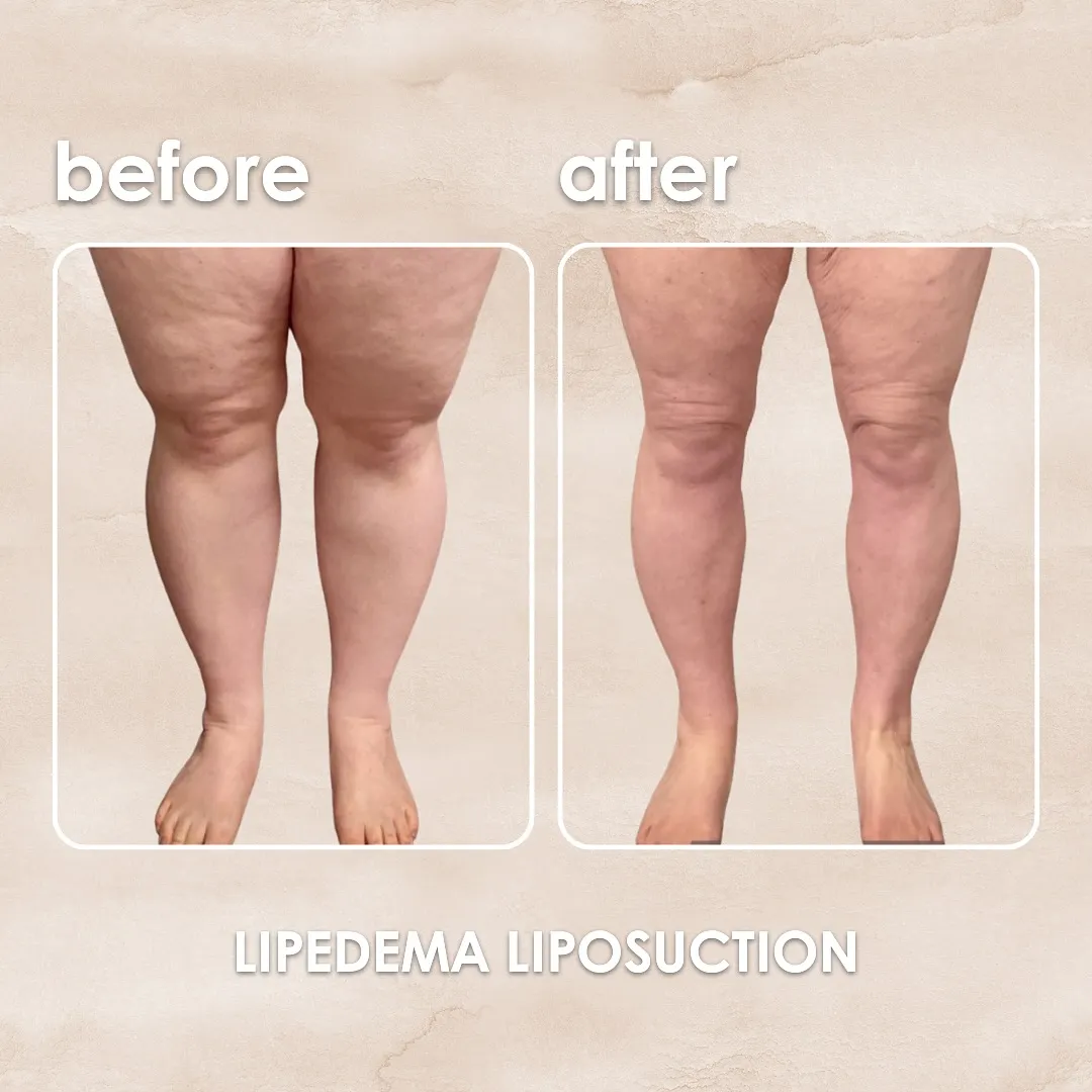 Lipedema before-and-after comparison.