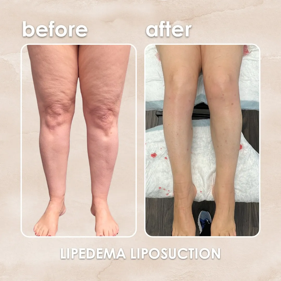 Lipedema before-and-after comparison.