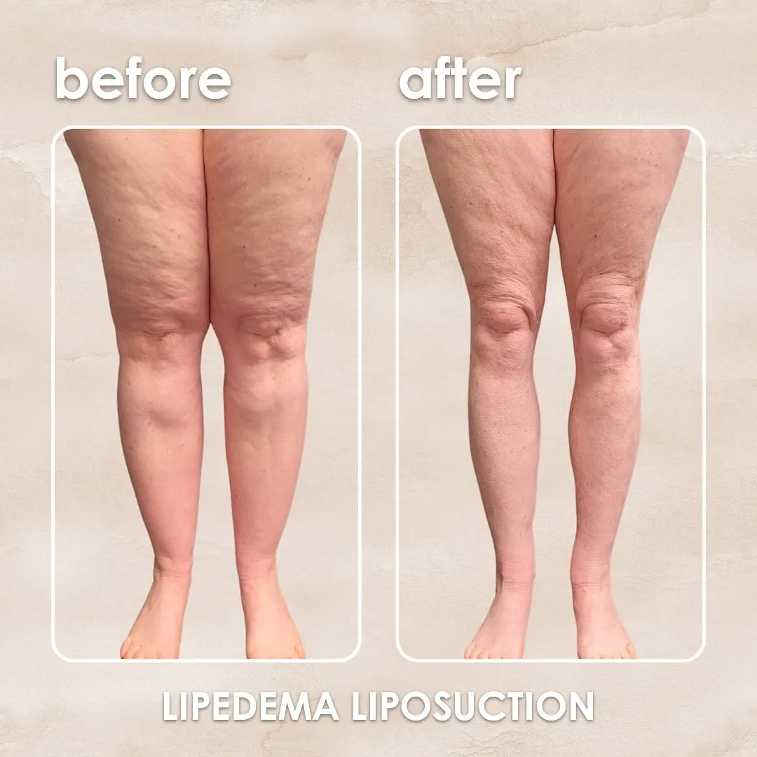 Lipedema before-and-after comparison.