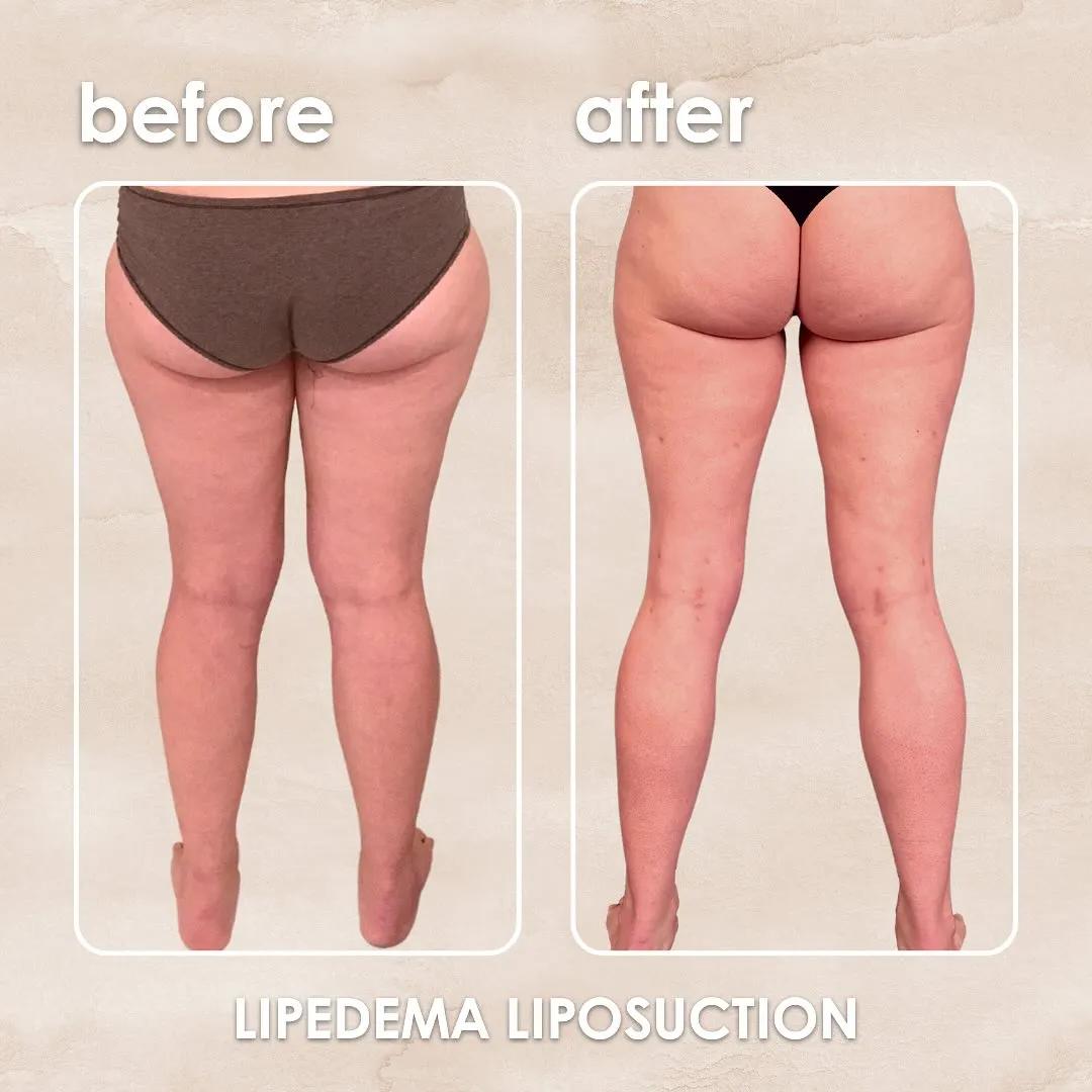 Lipedema before-and-after comparison.