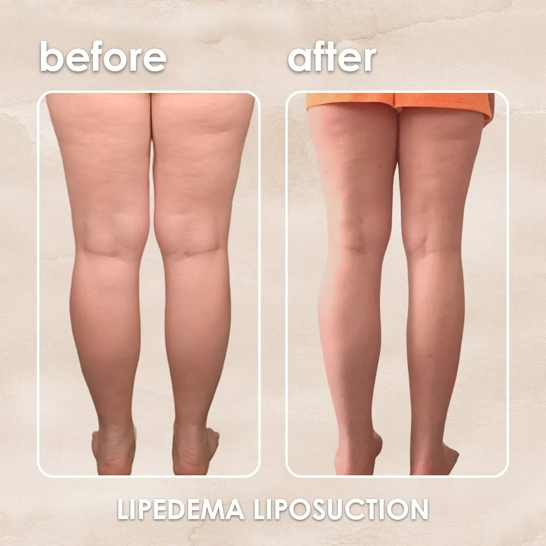 Lipedema before-and-after comparison.