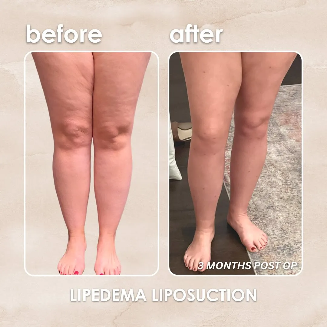 Lipedema before-and-after comparison.