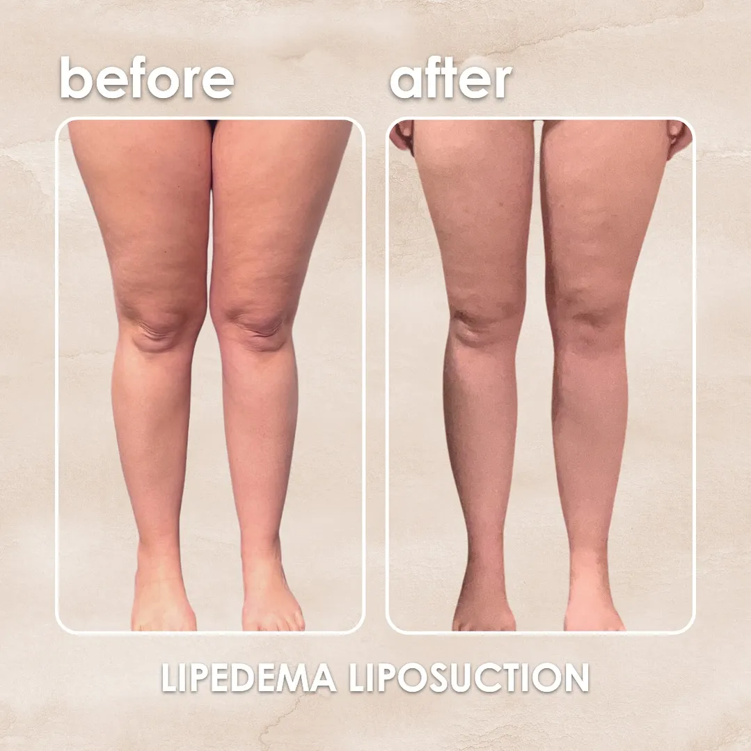 Lipedema before-and-after comparison.
