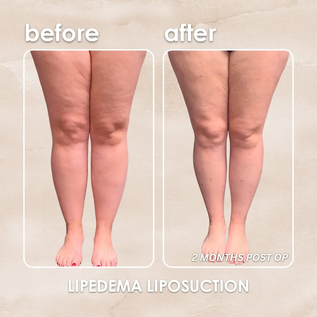 Lipedema before-and-after comparison.